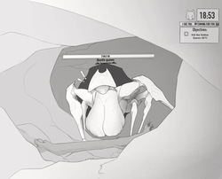 Beetle Queen got stuck while spawning in.